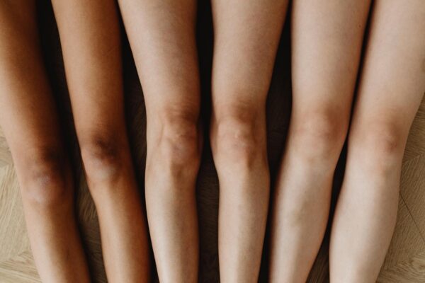 Knock knees